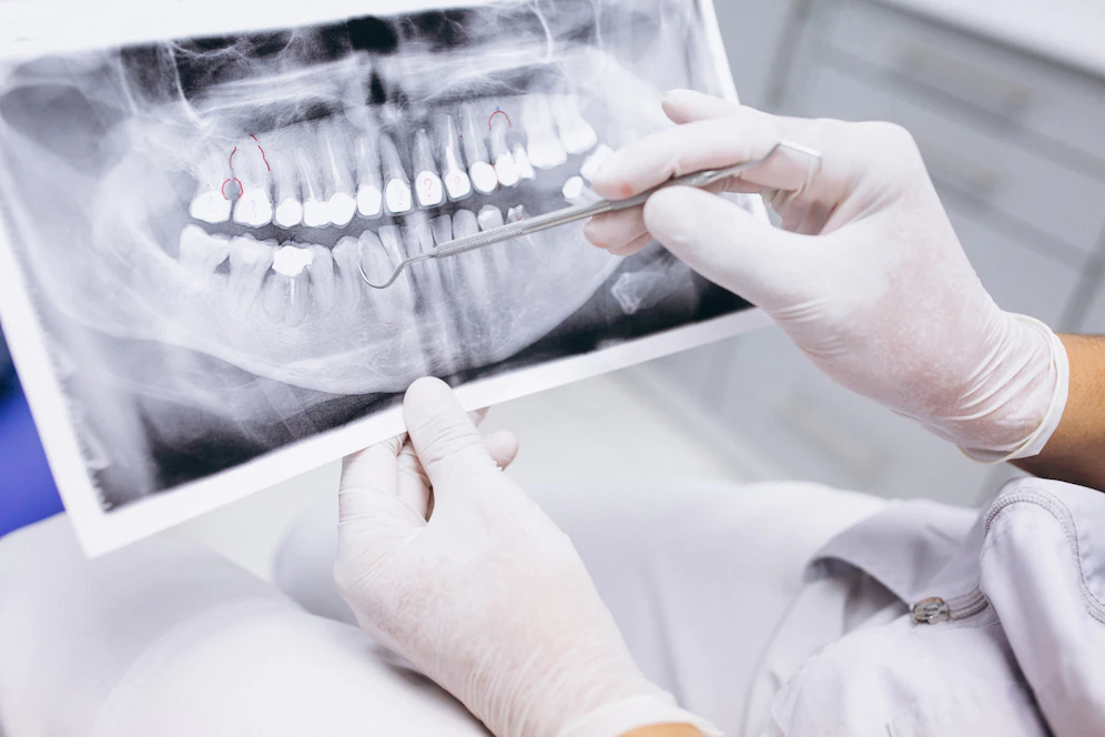 Стоматолог Балакирева перечислила, кому противопоказана установка зубных имплантов
