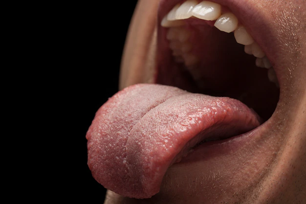 Терапевт Чиркова: При раке языка появляется патологический налет