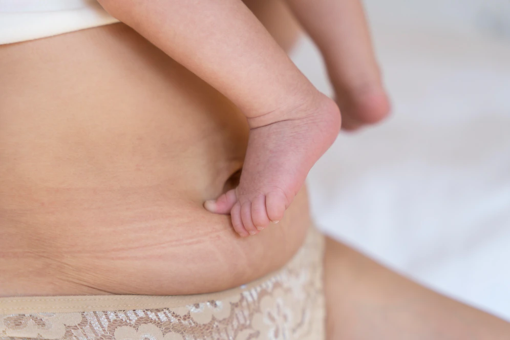 Хирург Мурзаева: Тренировки не всегда могут убрать живот после родов