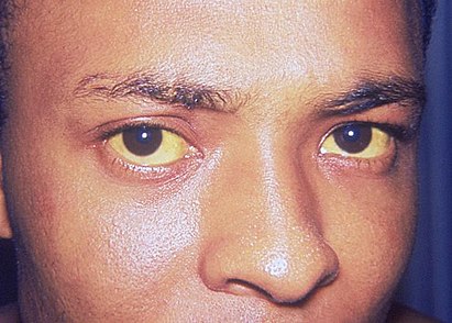 Хирург Умнов: При водочном алкоголизме желтеют белки глаз и краснеет нос