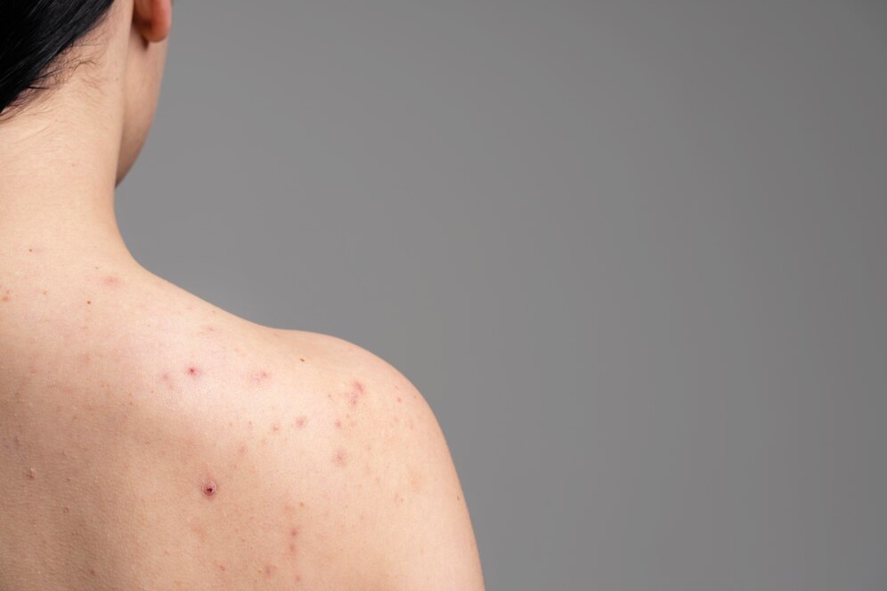 Дерматолог Кунг: Незаживающие 3 месяца прыщи могут указывать на рак кожи