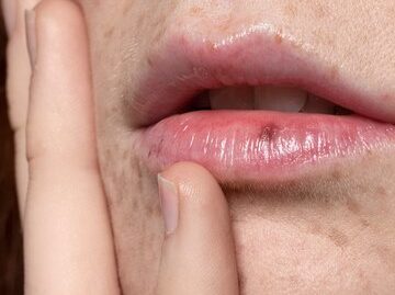 Фармаколог Эдигер: Заеды на губах сигнализируют об иммунодефиците и сахарном диабете