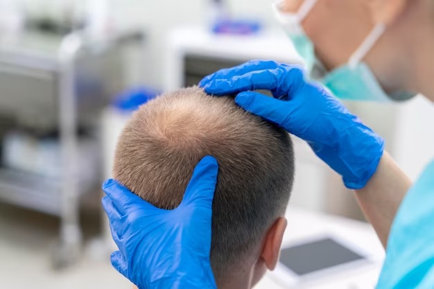 Трихолог Курская: Пересадка волос требуется при генетической алопеции