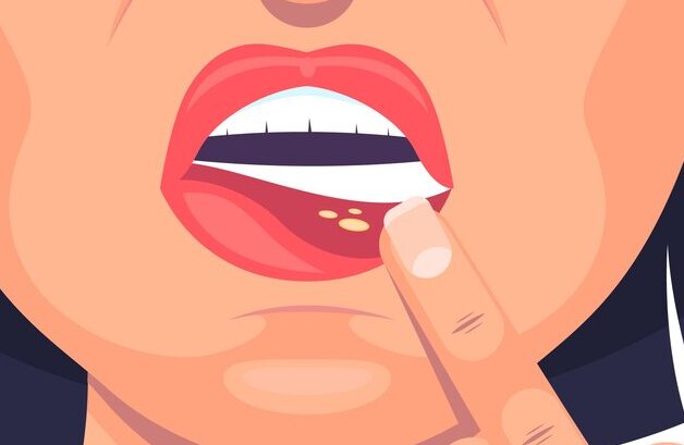 Терапевт Кондрахин: Стоматит может быть предвестником онкологии полости рта
