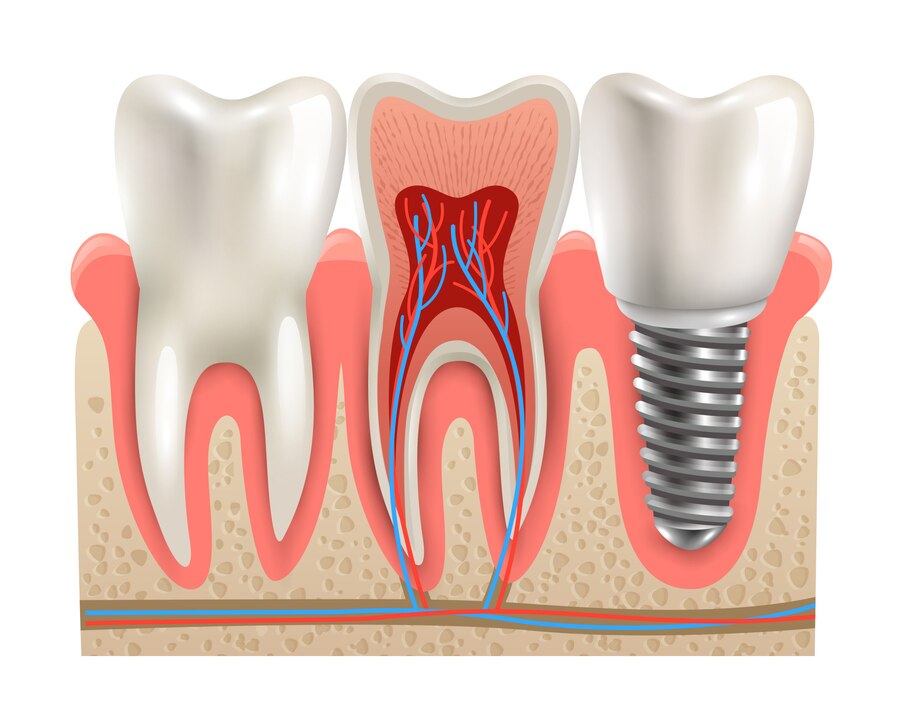 Стоматолог Минко: Импланты могут сохранить соседние зубы